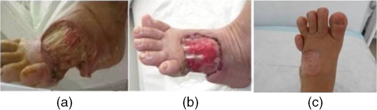 Intralesional epidermal growth factor for diabetic foot wounds: the first cases in Turkey.