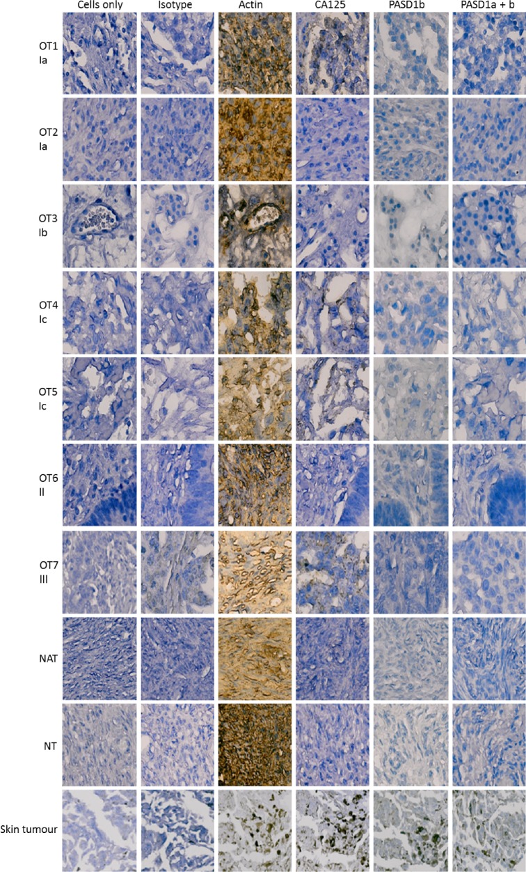 Infrequent Expression of the Cancer-Testis Antigen, PASD1, in Ovarian Cancer.