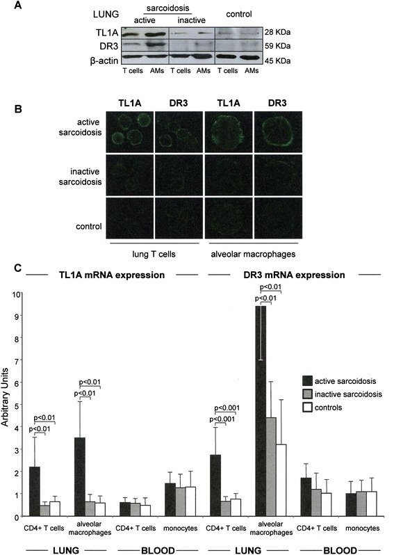 TL1A/DR3 axis involvement in the inflammatory cytokine network during pulmonary sarcoidosis.