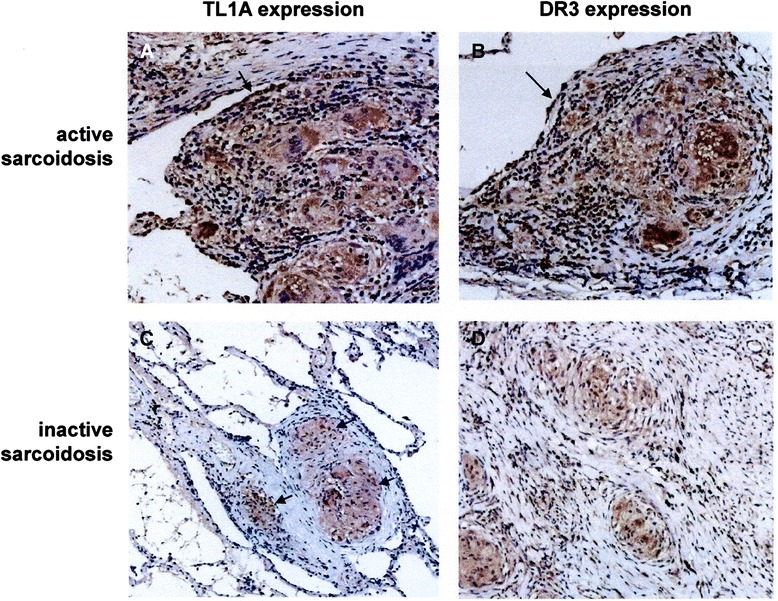 TL1A/DR3 axis involvement in the inflammatory cytokine network during pulmonary sarcoidosis.