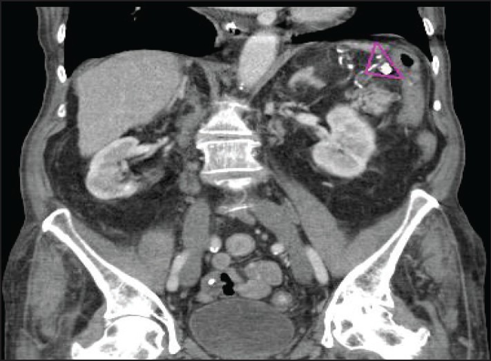 Hypoplasia of the Spleen: Review of Pathogenesis, Diagnosis, and Potential Clinical Implications.