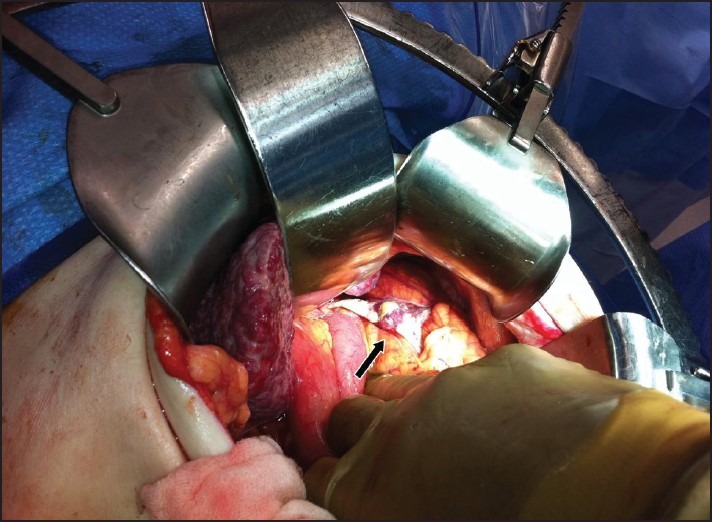 Hypoplasia of the Spleen: Review of Pathogenesis, Diagnosis, and Potential Clinical Implications.