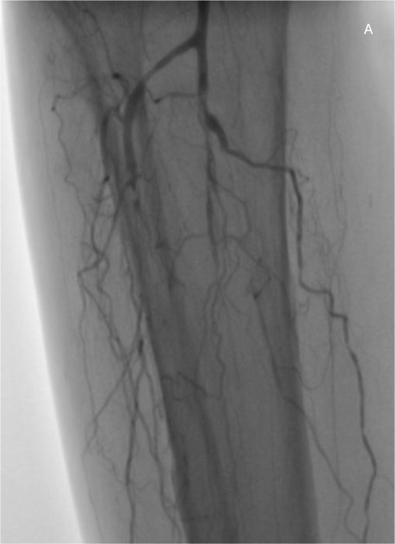 Retrograde pedal access with a 20-gauge intravenous cannula after failed antegrade recanalization of a tibialis anterior artery in a diabetic patient: a case report.