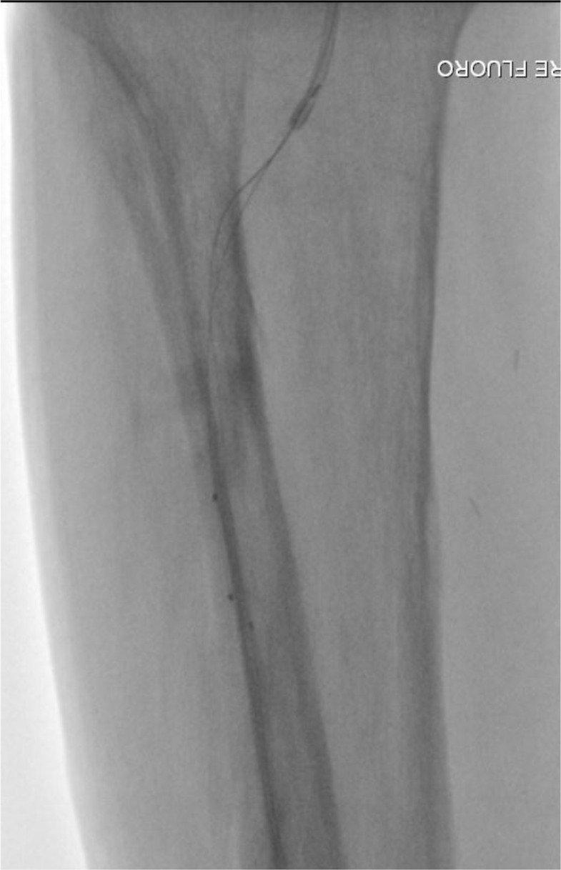 Retrograde pedal access with a 20-gauge intravenous cannula after failed antegrade recanalization of a tibialis anterior artery in a diabetic patient: a case report.