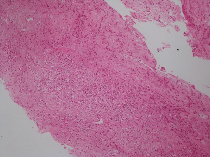 IgG4-related disease: case report and literature review.