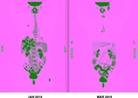 Successful use of next generation genomic sequencing (NGS)-directed therapy of clear cell carcinoma of the ovary (CCCO) with trametinib and metformin in a patient with chemotherapy-refractory disease.