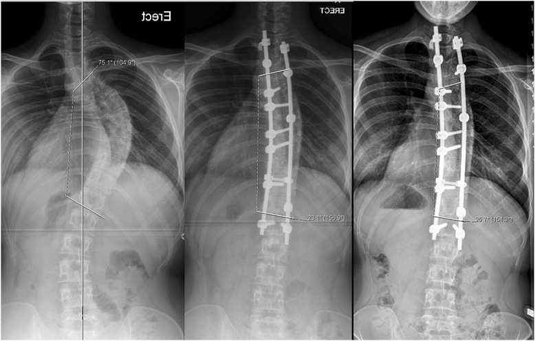 Surgical results with the use of Silicated Calcium Phosphate (SiCaP) as bone graft substitute in Posterior Spinal Fusion (PSF) for Adolescent Idiopathic Scoliosis (AIS).