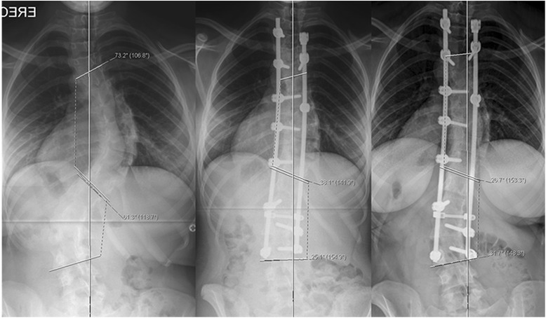 Surgical results with the use of Silicated Calcium Phosphate (SiCaP) as bone graft substitute in Posterior Spinal Fusion (PSF) for Adolescent Idiopathic Scoliosis (AIS).