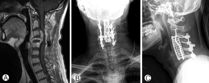 Epithelioid Sarcoma in the Cervical Spine: A Case Report.