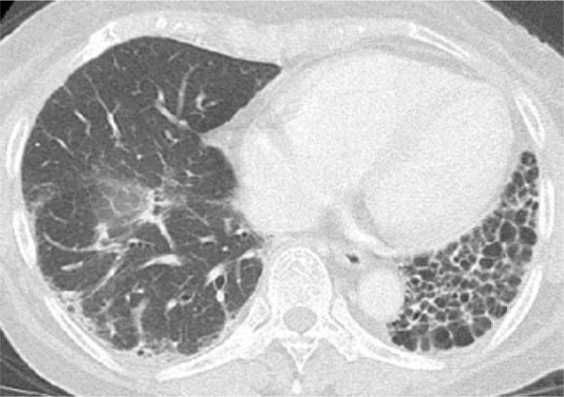 Interstitial Lung Disease with ANCA-associated Vasculitis.