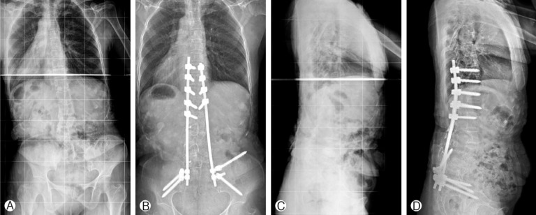 Posterior Spinal Reconstruction with Pedicle Screws, Multiple Iliac Screws and Wisconsin Spinal Wires in a Patient with Neurofibromatosis Scoliosis: A Case Report.