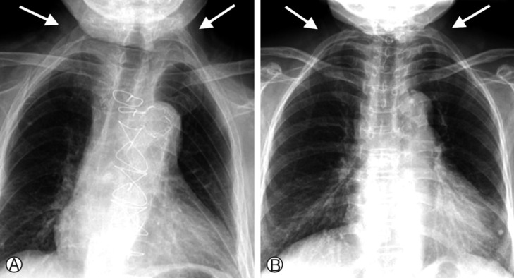 Two Cases of Klippel-Feil Syndrome with Cervical Myelopathy Successfully Treated by Simple Decompression without Fixation.