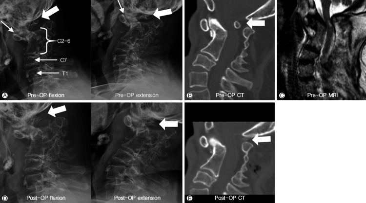 Two Cases of Klippel-Feil Syndrome with Cervical Myelopathy Successfully Treated by Simple Decompression without Fixation.