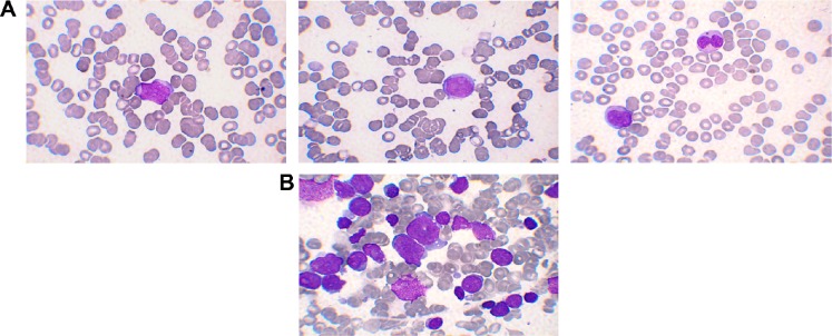 Mixed Phenotype Acute Leukemia with Two Immunophenotypically Distinct B and T Blasts Populations, Double Ph (+) Chromosome and Complex Karyotype: Report of an Unusual Case.