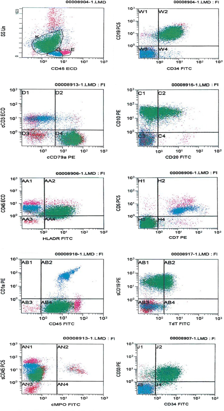 Mixed Phenotype Acute Leukemia with Two Immunophenotypically Distinct B and T Blasts Populations, Double Ph (+) Chromosome and Complex Karyotype: Report of an Unusual Case.