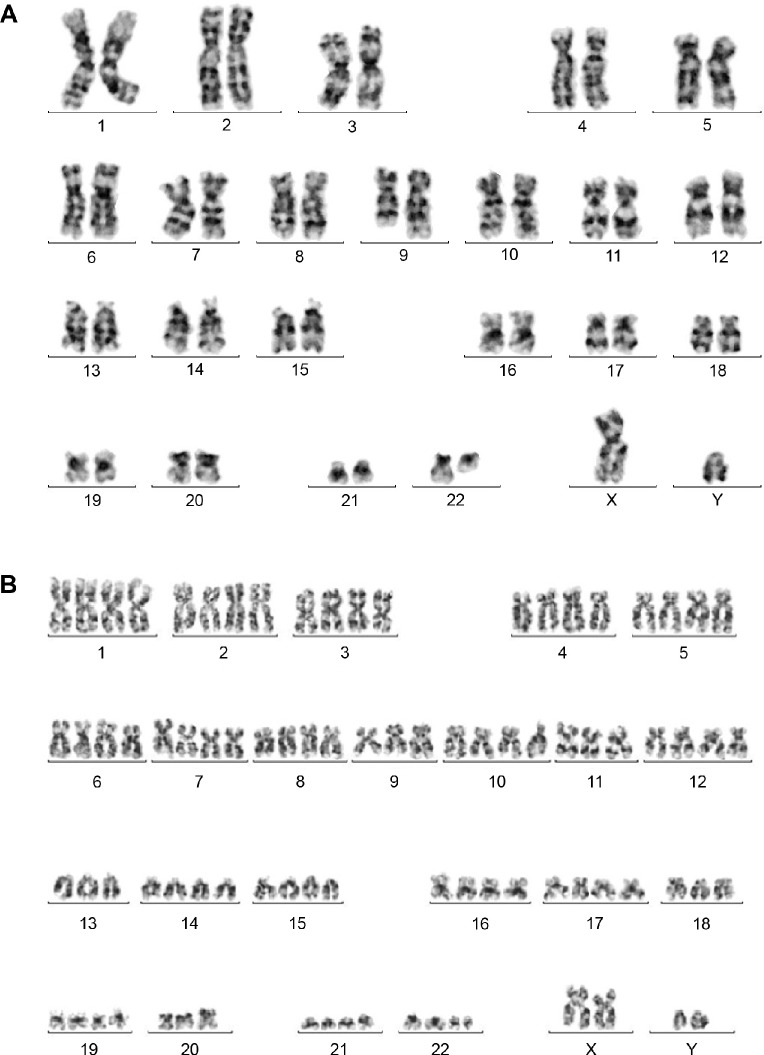 Mixed Phenotype Acute Leukemia with Two Immunophenotypically Distinct B and T Blasts Populations, Double Ph (+) Chromosome and Complex Karyotype: Report of an Unusual Case.