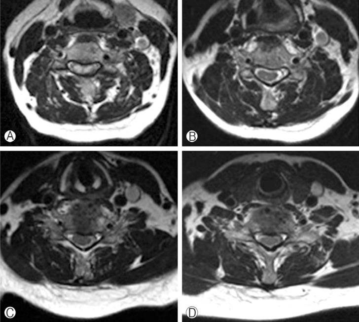 Delayed Bilateral C5 Palsy following Circumferential Decompression and Fusion in Patient with Cervical Spondylotic Myelopathy.