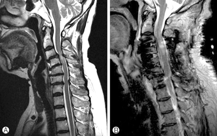 Delayed Bilateral C5 Palsy following Circumferential Decompression and Fusion in Patient with Cervical Spondylotic Myelopathy.