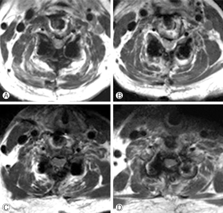 Delayed Bilateral C5 Palsy following Circumferential Decompression and Fusion in Patient with Cervical Spondylotic Myelopathy.