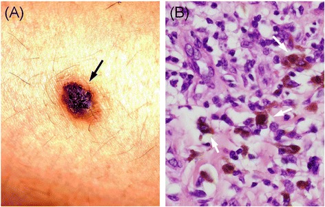 Ruptured hepatic metastases of cutaneous melanoma during treatment with vemurafenib: an autopsy case report.