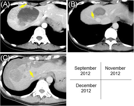 Ruptured hepatic metastases of cutaneous melanoma during treatment with vemurafenib: an autopsy case report.