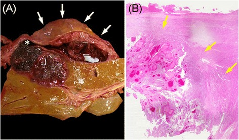 Ruptured hepatic metastases of cutaneous melanoma during treatment with vemurafenib: an autopsy case report.