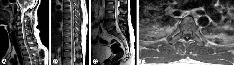 Spontaneous Spinal Epidural Hematoma on the Ventral Portion of Whole Spinal Canal: A Case Report.