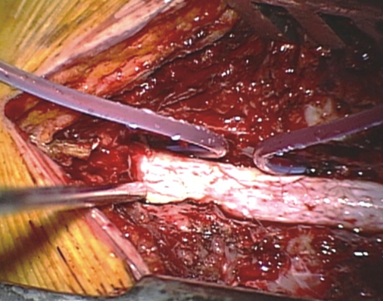 Spontaneous Spinal Epidural Hematoma on the Ventral Portion of Whole Spinal Canal: A Case Report.