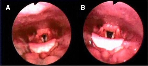 Vocal cord dysfunction: a review.