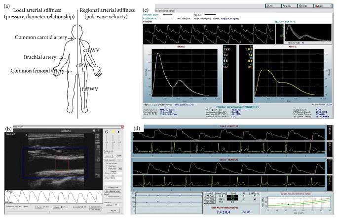 Children and Adolescent Obesity Associates with Pressure-Dependent and Age-Related Increase in Carotid and Femoral Arteries' Stiffness and Not in Brachial Artery, Indicative of Nonintrinsic Arterial Wall Alteration.