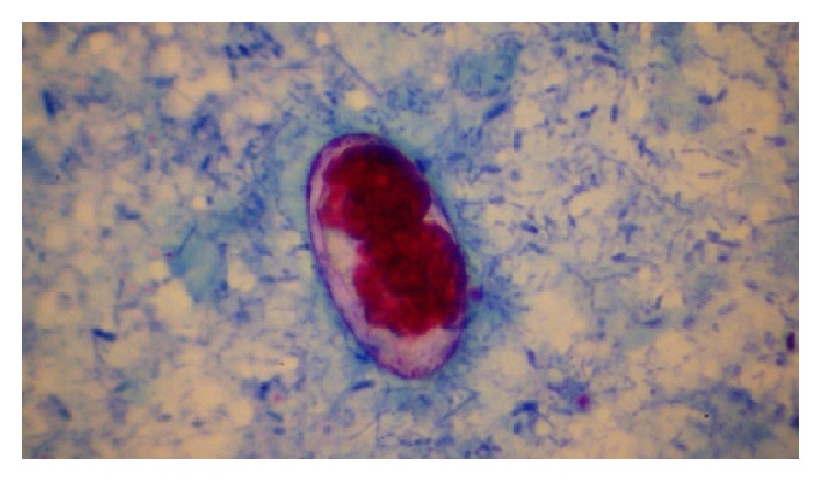 Intestinal Parasite Profile in the Stool of HIV Positive Patients in relation to Immune Status and Comparison of Various Diagnostic Techniques with Special Reference to Cryptosporidium at a Tertiary Care Hospital in South India.