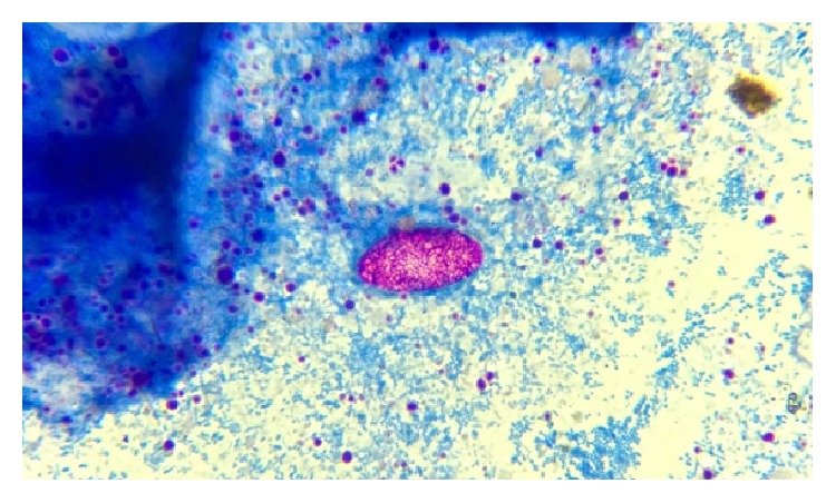 Intestinal Parasite Profile in the Stool of HIV Positive Patients in relation to Immune Status and Comparison of Various Diagnostic Techniques with Special Reference to Cryptosporidium at a Tertiary Care Hospital in South India.