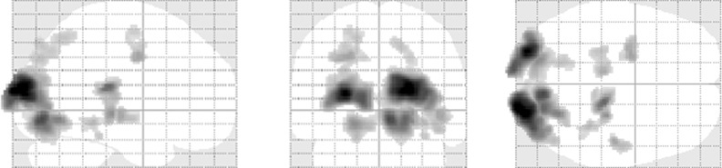 Differences in Brain Hemodynamics in Response to Achromatic and Chromatic Cards of the Rorschach: A fMRI Study.