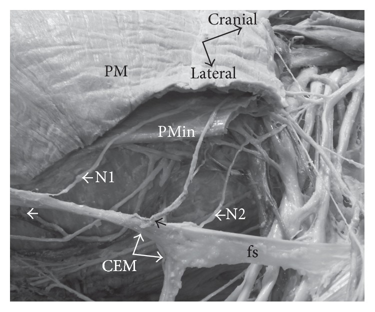 Bilateral Chondroepitrochlearis Muscle: Case Report, Phylogenetic Analysis, and Clinical Significance.