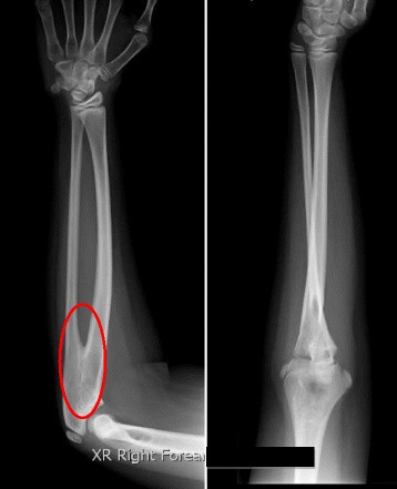 A rare 47 XXY/46 XX mosaicism with clinical features of Klinefelter syndrome.