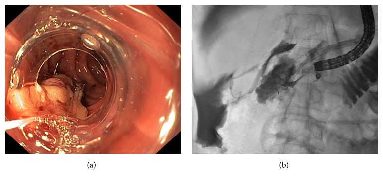 Efficacy of the Ovesco Clip for Closure of Endoscope Related Perforations.