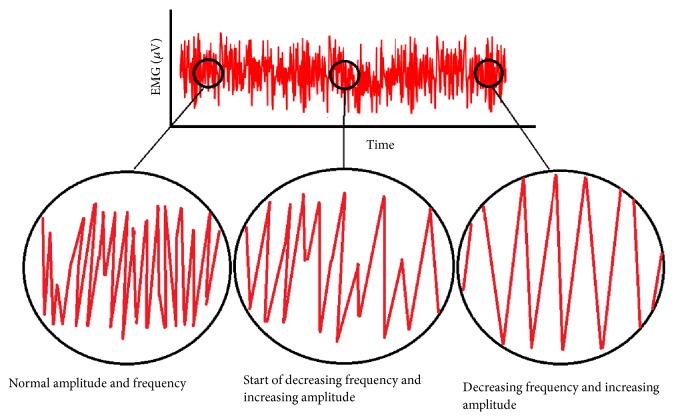 Prediction of Muscle Fatigue during Minimally Invasive Surgery Using Recurrence Quantification Analysis.