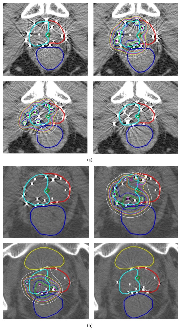 Salvage Brachytherapy for Biochemically Recurrent Prostate Cancer following Primary Brachytherapy.