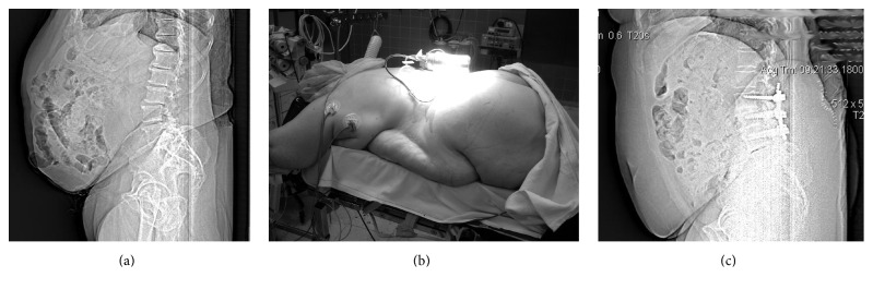 The Negligible Influence of Chronic Obesity on Hospitalization, Clinical Status, and Complications in Elective Posterior Lumbar Interbody Fusion.