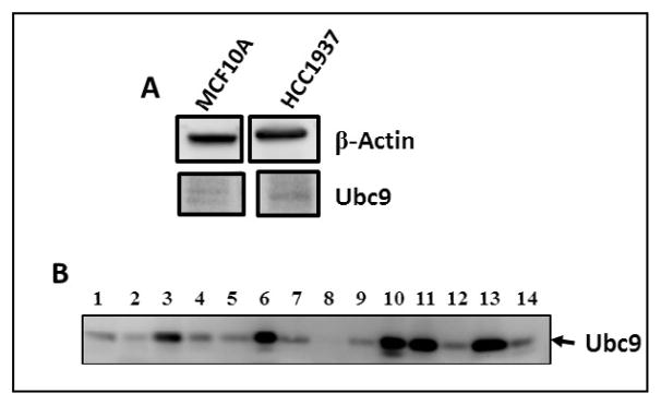 BRCA1 Mutation Leads to Deregulated Ubc9 Levels which Triggers Proliferation and Migration of Patient-Derived High Grade Serous Ovarian Cancer and Triple Negative Breast Cancer Cells.