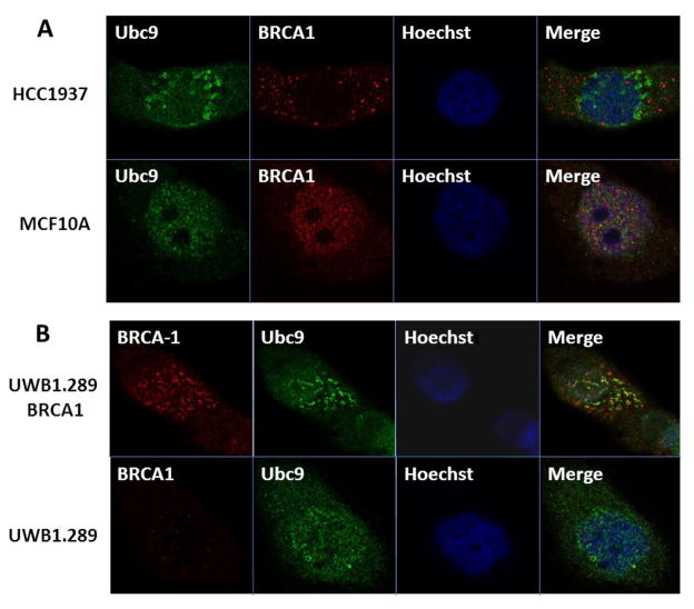 BRCA1 Mutation Leads to Deregulated Ubc9 Levels which Triggers Proliferation and Migration of Patient-Derived High Grade Serous Ovarian Cancer and Triple Negative Breast Cancer Cells.