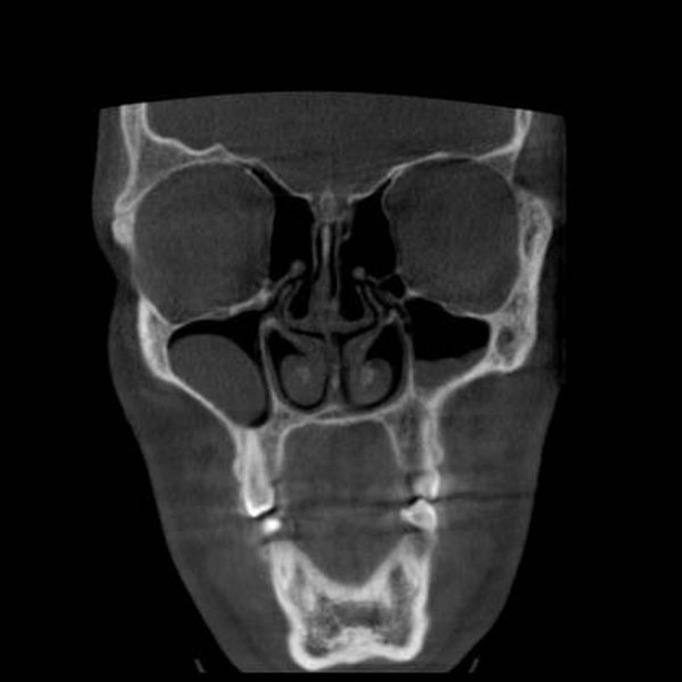 Paranasal sinus pathoses on cone beam computed tomography.