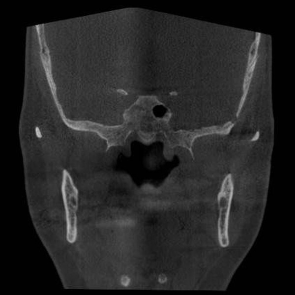 Paranasal sinus pathoses on cone beam computed tomography.