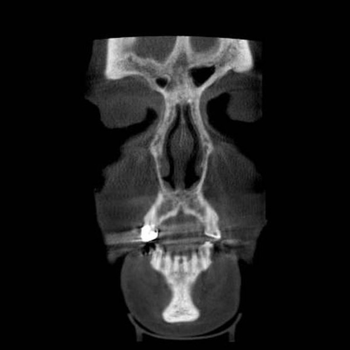 Paranasal sinus pathoses on cone beam computed tomography.