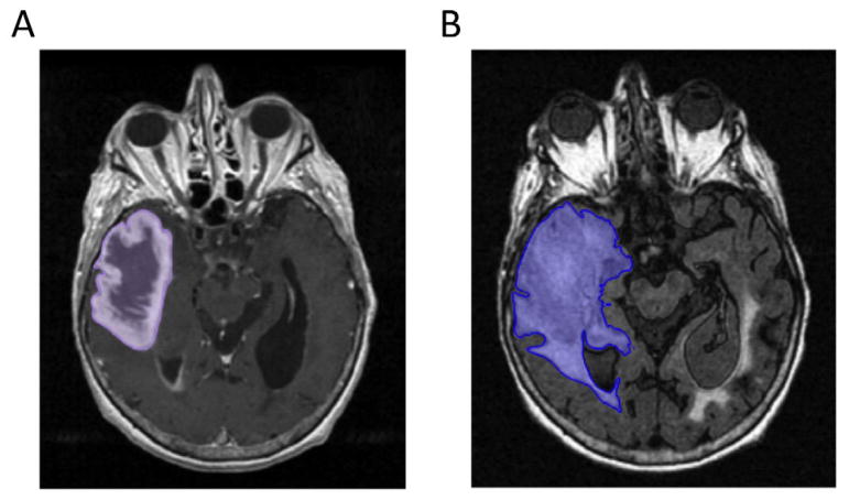 Assessing the Effects of Software Platforms on Volumetric Segmentation of Glioblastoma.