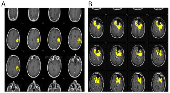 Assessing the Effects of Software Platforms on Volumetric Segmentation of Glioblastoma.