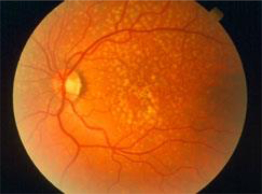 Oxidative stress, innate immunity, and age-related macular degeneration.