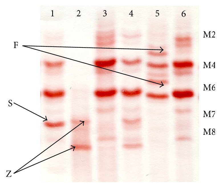 The Diagnostic Value of Alpha-1-Antitrypsin Phenotype in Patients with Granulomatosis with Polyangiitis.