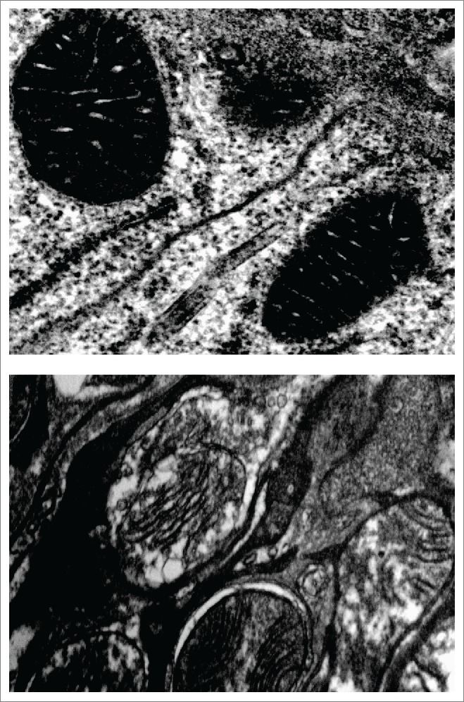 Mitochondrial dysfunction and defects in lipid homeostasis as therapeutic targets in neurodegeneration with brain iron accumulation.