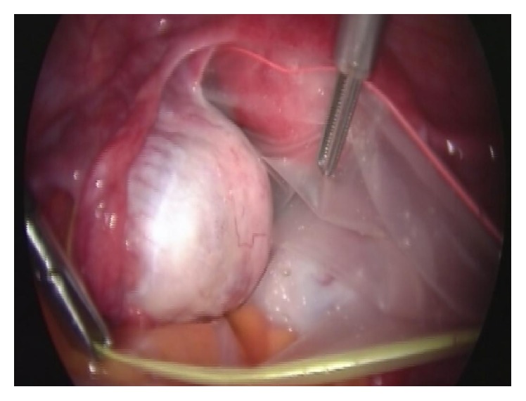 Laparoscopic Cystectomy In-a-Bag of an Intact Cyst: Is It Feasible and Spillage-Free After All?